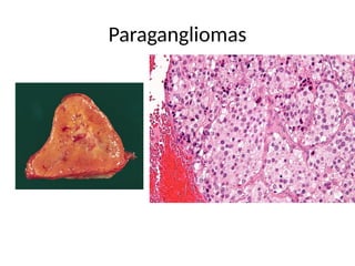 Paragangliomas
 