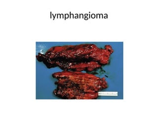 lymphangioma
 