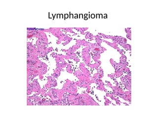 Lymphangioma
 