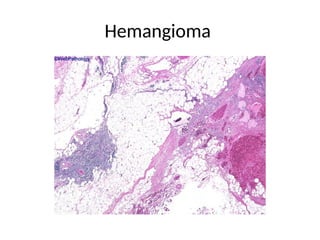 Hemangioma
 