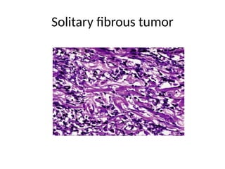 Solitary fibrous tumor
 