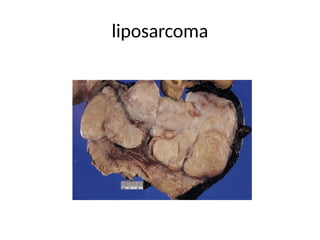 liposarcoma
 