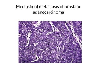 Mediastinal metastasis of prostatic
adenocarcinoma
 