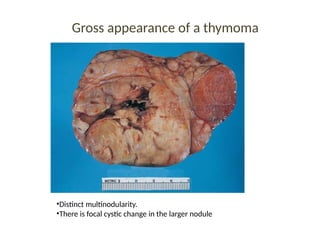 Gross appearance of a thymoma
•Distinct multinodularity.
•There is focal cystic change in the larger nodule
 