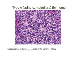Type A (spindle, medullary) thymoma.
The pseudomesenchymal appearance of the tumor is striking.
 