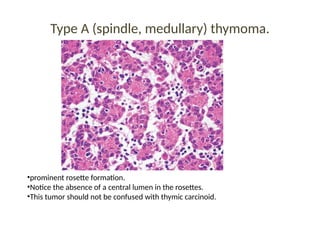 Type A (spindle, medullary) thymoma.
•prominent rosette formation.
•Notice the absence of a central lumen in the rosettes.
•This tumor should not be confused with thymic carcinoid.
 