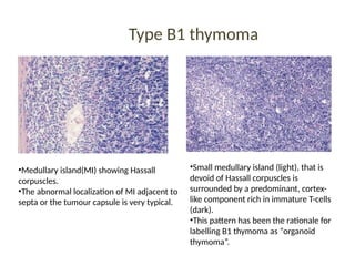 Type B1 thymoma
•Medullary island(MI) showing Hassall
corpuscles.
•The abnormal localization of MI adjacent to
septa or the tumour capsule is very typical.
•Small medullary island (light), that is
devoid of Hassall corpuscles is
surrounded by a predominant, cortex-
like component rich in immature T-cells
(dark).
•This pattern has been the rationale for
labelling B1 thymoma as “organoid
thymoma”.
 