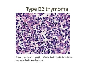 Type B2 thymoma
There is an even proportion of neoplastic epithelial cells and
non-neoplastic lymphocytes.
 