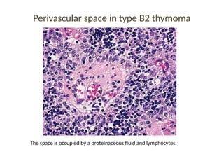 Perivascular space in type B2 thymoma
The space is occupied by a proteinaceous fluid and lymphocytes.
 