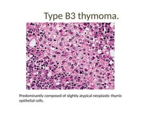 Type B3 thymoma.
Predominantly composed of slightly atypical neoplastic thymic
epithelial cells.
 