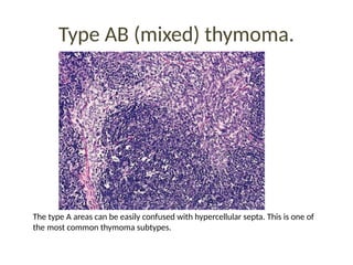Type AB (mixed) thymoma.
The type A areas can be easily confused with hypercellular septa. This is one of
the most common thymoma subtypes.
 