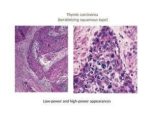 Thymic carcinoma
(keratinizing squamous type)
Low-power and high-power appearances
 