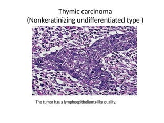 Thymic carcinoma
(Nonkeratinizing undifferentiated type )
The tumor has a lymphoepithelioma-like quality.
 