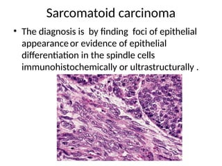 Sarcomatoid carcinoma
• The diagnosis is by finding foci of epithelial
appearanceor evidence of epithelial
differentiation in the spindle cells
immunohistochemically or ultrastructurally .
 
