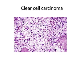 Clear cell carcinoma
 