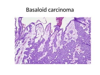 Basaloid carcinoma
 