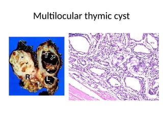 Multilocular thymic cyst
 