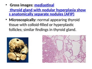 • Gross images: mediastinal
thyroid gland with nodular hyperplasia show
s anatomically separate nodules (AFIP)
• Microscopically: normal appearing thyroid
tissue with colloid-filled or hyperplastic
follicles; similar findings in thyroid gland.
 