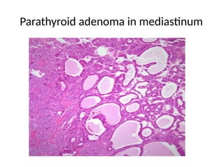 Parathyroid adenoma in mediastinum
 
