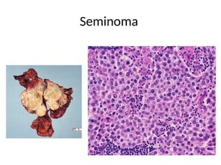 Seminoma
 