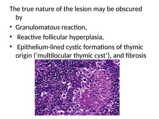 The true nature of the lesion may be obscured
by
• Granulomatous reaction,
• Reactive follicular hyperplasia,
• Epithelium-lined cystic formations of thymic
origin (‘multilocular thymic cyst’), and fibrosis.
 