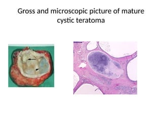Gross and microscopic picture of mature
cystic teratoma
 