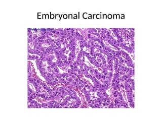 Embryonal Carcinoma
 