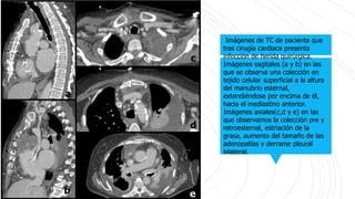 Imágenes de TC de paciente que
tras cirugía cardiaca presenta
infección de herida quirúrgica.
Imágenes sagitales (a y b) en las
que se observa una colección en
tejido celular superficial a la altura
del manubrio esternal,
extendiéndose por encima de él,
hacia el mediastino anterior.
Imágenes axiales(c,d y e) en las
que observamos la colección pre y
retroesternal, estriación de la
grasa, aumento del tamaño de las
adenopatías y derrame pleural
bilateral.
 