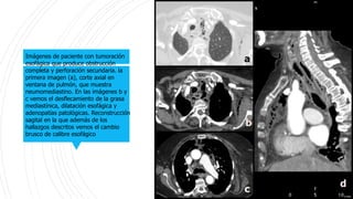 Imágenes de paciente con tumoración
esofágica que produce obstrucción
completa y perforación secundaria. la
primera imagen (a), corte axial en
ventana de pulmón, que muestra
neumomediastino. En las imágenes b y
c vemos el desflecamiento de la grasa
mediastínica, dilatación esofágica y
adenopatías patológicas. Reconstrucción
sagital en la que además de los
hallazgos descritos vemos el cambio
brusco de calibre esofágico
 