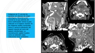 Imágenes de TC cervical de
paciente con absceso de origen
odontógeno. Reconstrucción
coronal en la que además del
bocio multinodular vemos la gran
colección en el espacio visceral. En
las imágenes axiales nombradas
como b, vemos la afectación del
espacio visceral así como del
espacio retrofaringeo. La
reconstrucción sagital muestra
como se extienden estas
colecciones hacia mediastino
 