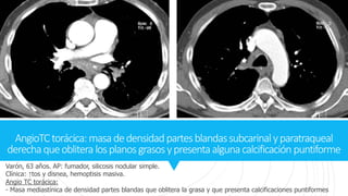 AngioTCtorácica:masadedensidadpartesblandassubcarinalyparatraqueal
derechaqueoblitera losplanosgrasosypresentaalgunacalcificación puntiforme
Varón, 63 años. AP: fumador, silicosis nodular simple.
Clínica: ↑tos y disnea, hemoptisis masiva.
Angio TC torácica:
- Masa mediastínica de densidad partes blandas que oblitera la grasa y que presenta calcificaciones puntiformes
 