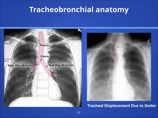 27
Tracheobronchial anatomy
Tracheal Displacement Due to Goiter
 