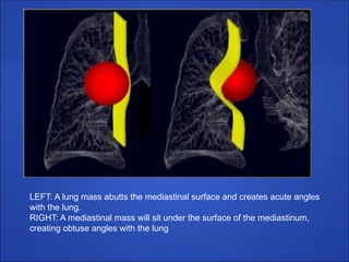 LEFT: A lung mass abutts the mediastinal surface and creates acute angles
with the lung.
RIGHT: A mediastinal mass will sit under the surface of the mediastinum,
creating obtuse angles with the lung
 