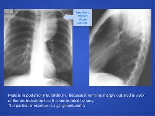 See sharp
margin
above
clavicle
Mass is in posterior mediastinum. because it remains sharply outlined in apex
of thorax, indicating that it is surrounded by lung.
This particular example is a ganglioneuroma
 