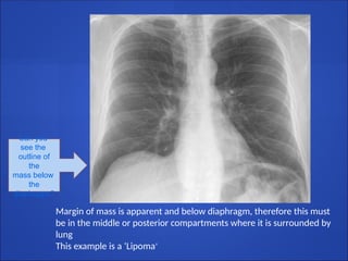 Can you
see the
outline of
the
mass below
the
diaphragm?
Margin of mass is apparent and below diaphragm, therefore this must
be in the middle or posterior compartments where it is surrounded by
lung
This example is a ‘Lipoma’
 