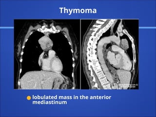 Thymoma
● lobulated mass in the anterior
mediastinum
 