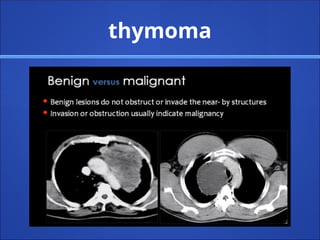 thymoma
 