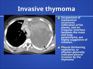 Invasive thymoma
● Encasement of
mediastinal
structures,
infiltration of fat
planes, and an
irregular interface
between the mass
and lung
parenchyma, are
highly suggestive of
invasion.
● Pleural thickening,
nodularity, or
effusion generally
indicates pleural
invasion by the
thymoma
 