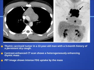 ● Thymic carcinoid tumor in a 22-year-old man with a 3-month history of
a persistent dry cough.
● Contrast-enhanced CT scan shows a heterogeneously enhancing
thymic mass .
● PET image shows intense FDG uptake by the mass
 