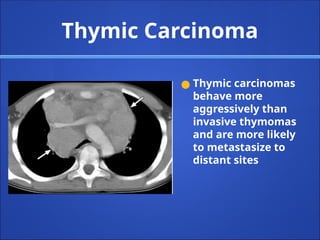 Thymic Carcinoma
● Thymic carcinomas
behave more
aggressively than
invasive thymomas
and are more likely
to metastasize to
distant sites
 