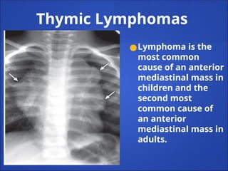Thymic Lymphomas
●Lymphoma is the
most common
cause of an anterior
mediastinal mass in
children and the
second most
common cause of
an anterior
mediastinal mass in
adults.
 