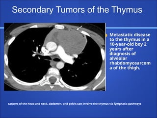 cancers of the head and neck, abdomen, and pelvis can involve the thymus via lymphatic pathways
● Metastatic disease
to the thymus in a
10-year-old boy 2
years after
diagnosis of
alveolar
rhabdomyosarcom
a of the thigh.
Secondary Tumors of the Thymus
 