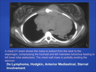 A chest CT exam shows the mass to extend from the neck to the
diaphragm, compressing the tracheal and left mainstem bronchus leading to
left lower lobe atelectasis. The chest wall mass is partially eroding the
sternum.
Dx:Lymphoma, Hodgkin, Anterior Mediastinal, Sternal
Involvement
 