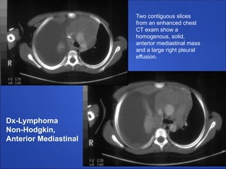 Two contiguous slices
from an enhanced chest
CT exam show a
homogenous, solid,
anterior mediastinal mass
and a large right pleural
effusion.
Dx-Lymphoma
Non-Hodgkin,
Anterior Mediastinal
 