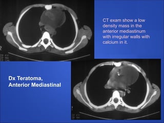 Dx Teratoma,
Anterior Mediastinal
CT exam show a low
density mass in the
anterior mediastinum
with irregular walls with
calcium in it.
 