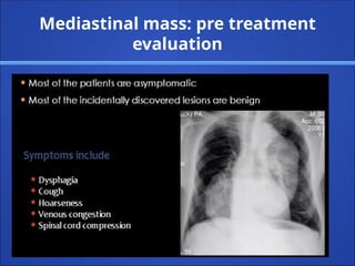 Mediastinal mass: pre treatment
evaluation
 