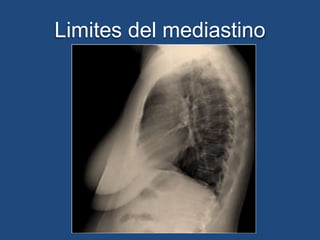 Limites del mediastino
 