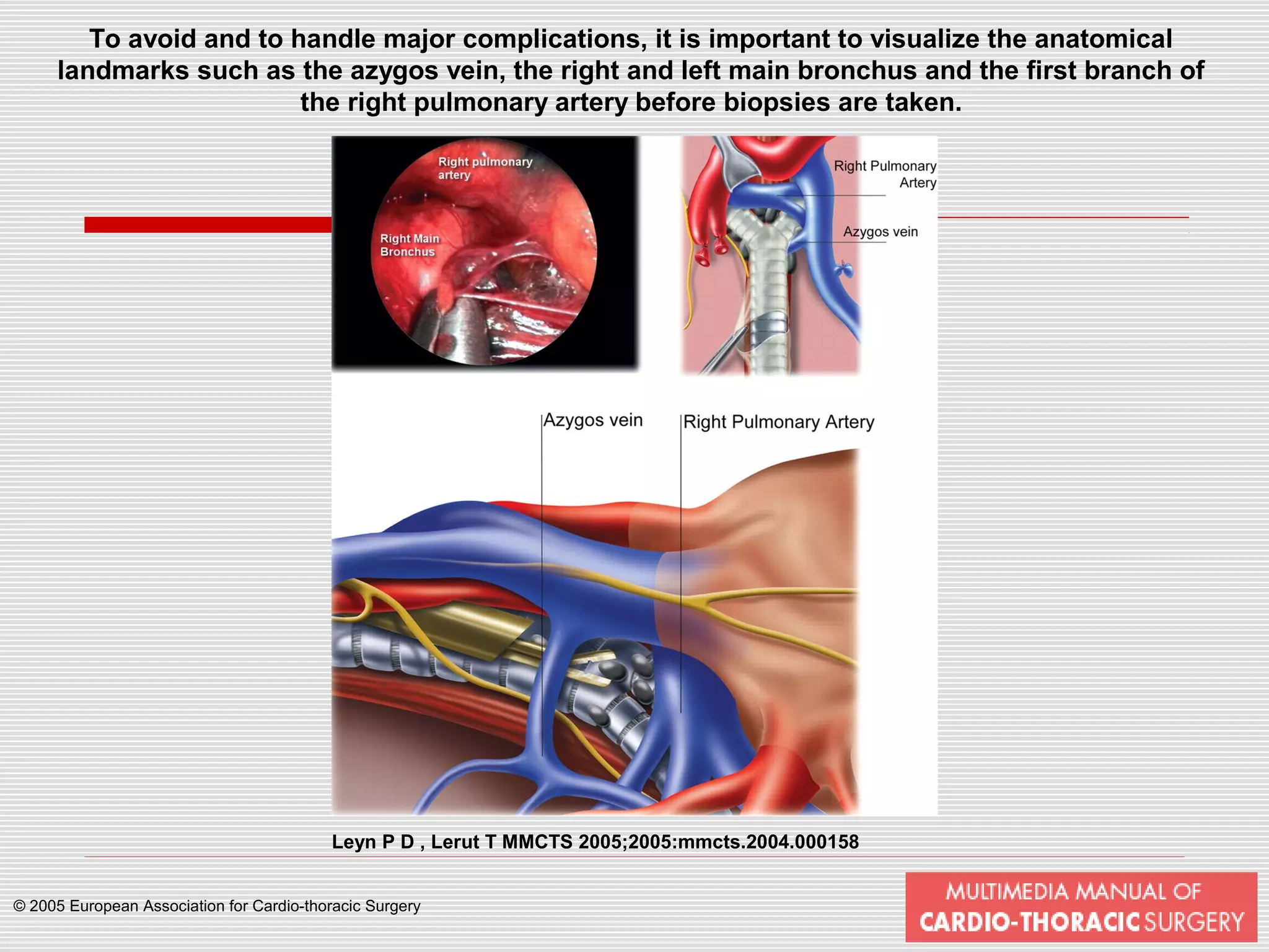 Mediastinoscopy Mediastinotomy Indications Techniques PPT mediastinoscopy-mediastinotomy-indications-techniques-ppt