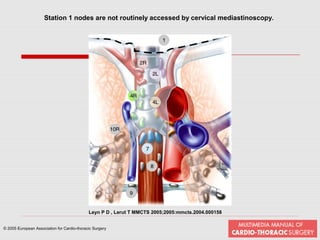 Mediastinoscopy & mediastinotomy indications & techniques | PPT