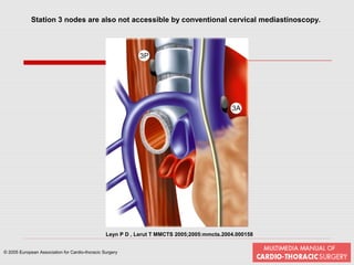 Mediastinoscopy & mediastinotomy indications & techniques | PPT